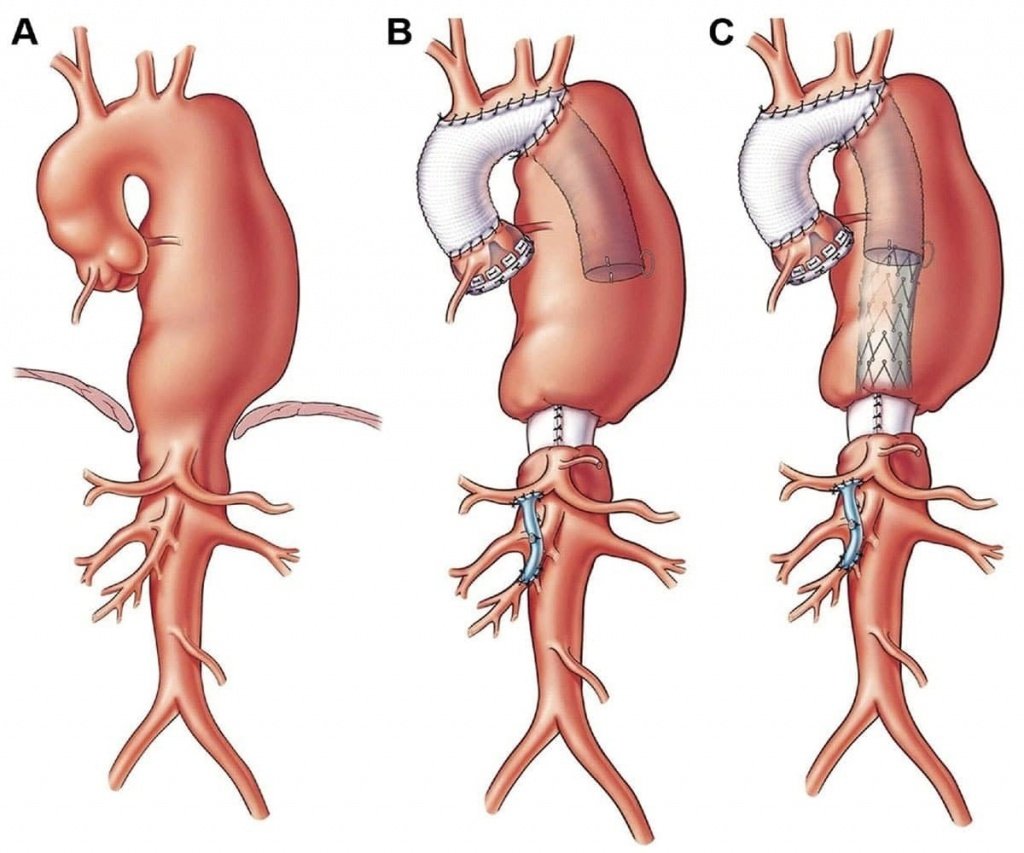 aneursima-aorta-addominale2
