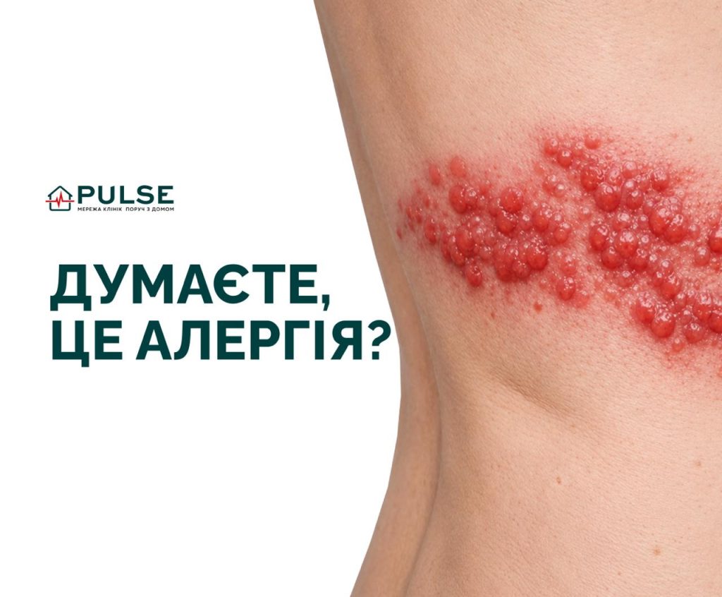 Думаєте, це алергія? Насправді це може бути вірус вітрянки або оперізуючий лишай
